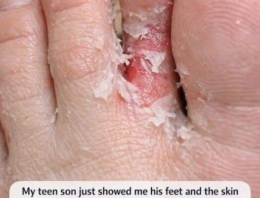 My Teen Son Showed Me His Feet and the Skin Is Peeling Between His Toes