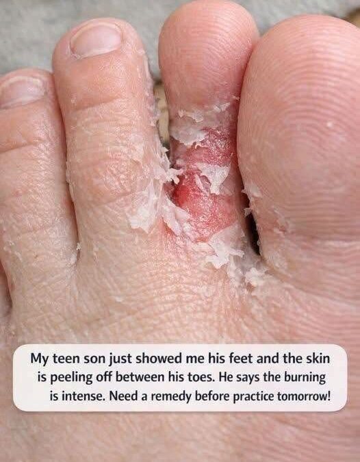 My Teen Son Showed Me His Feet and the Skin Is Peeling Between His Toes